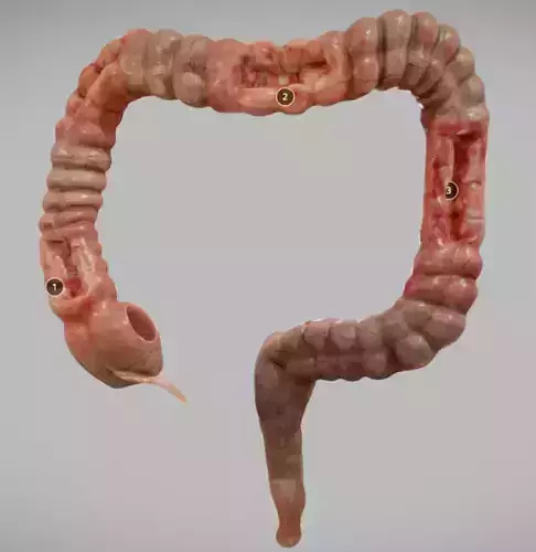 Crohns Disease Low-poly 3D model