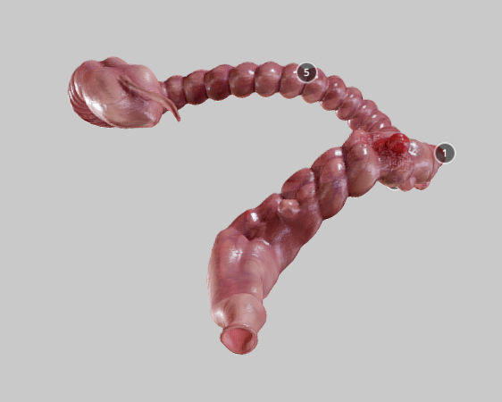 Diverticulosis and Diverticulitis Low-poly 3D model_14