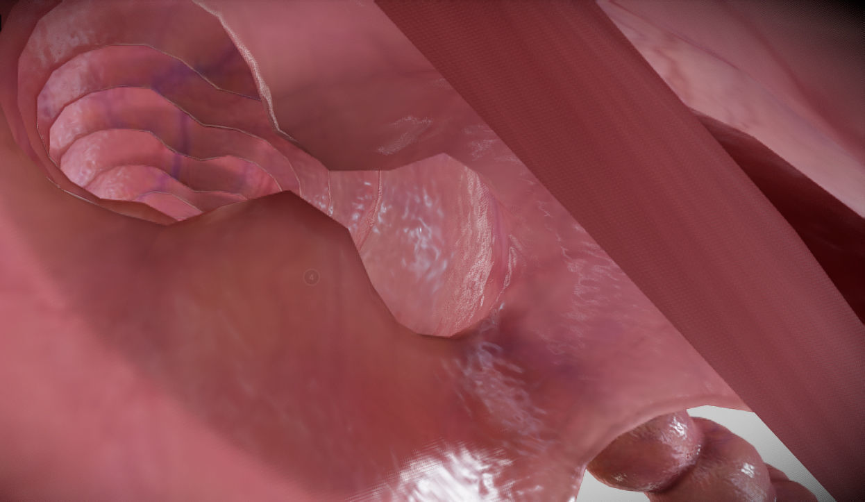 Diverticulosis and Diverticulitis Low-poly 3D model_29