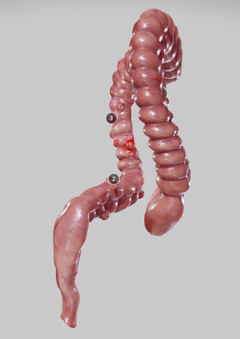 Diverticulosis and Diverticulitis Low-poly 3D model_6