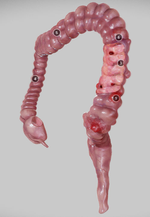 Diverticulosis and Diverticulitis Low-poly 3D model_22