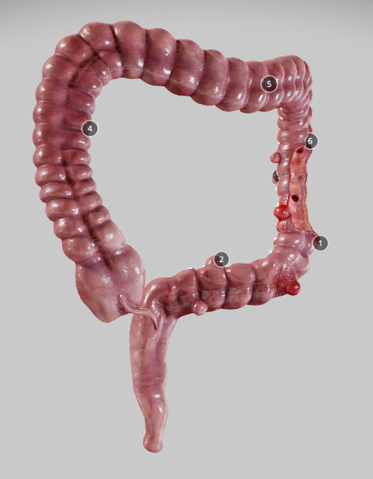 Diverticulosis and Diverticulitis Low-poly 3D model_9