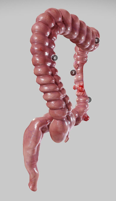 Diverticulosis and Diverticulitis Low-poly 3D model_7