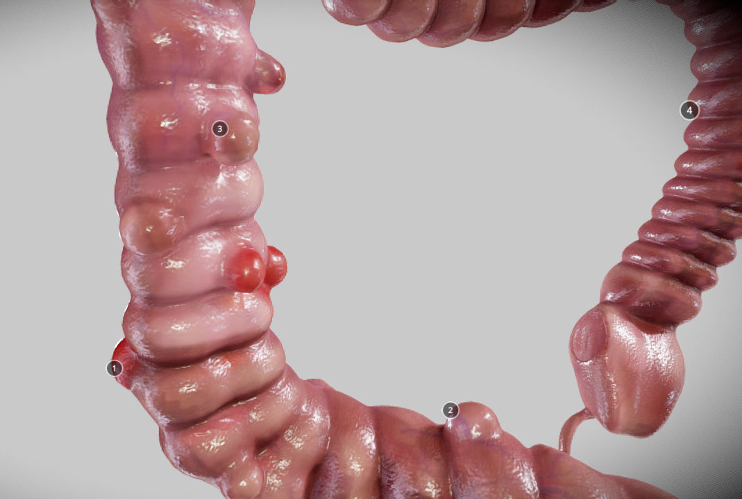 Diverticulosis and Diverticulitis Low-poly 3D model_24
