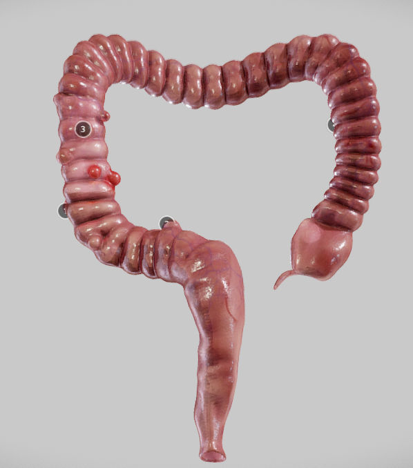 Diverticulosis and Diverticulitis Low-poly 3D model_1