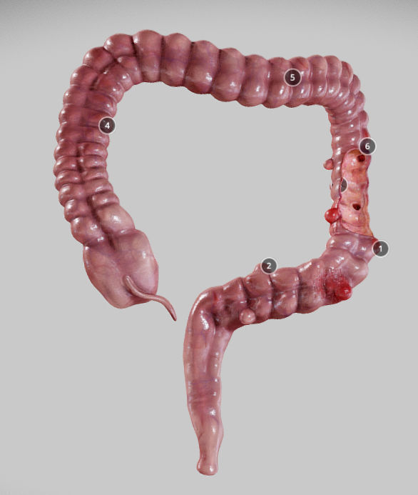 Diverticulosis and Diverticulitis Low-poly 3D model_12