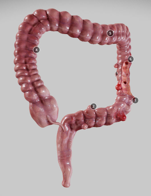 Diverticulosis and Diverticulitis Low-poly 3D model_10