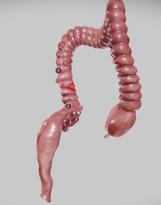 Diverticulosis and Diverticulitis Low-poly 3D model_5