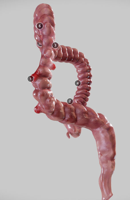 Diverticulosis and Diverticulitis Low-poly 3D model_32