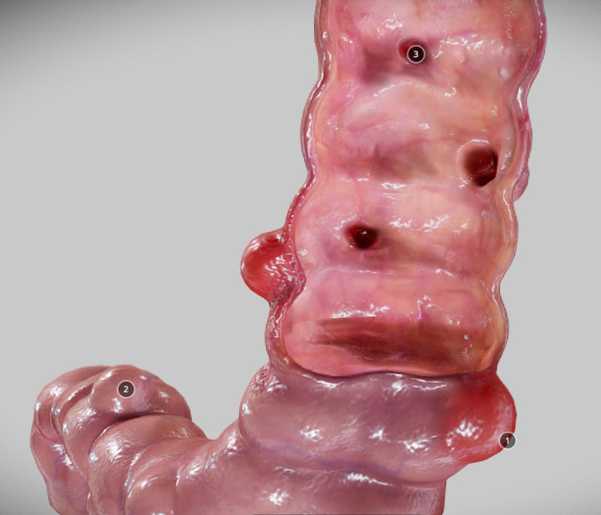 Diverticulosis and Diverticulitis Low-poly 3D model_18