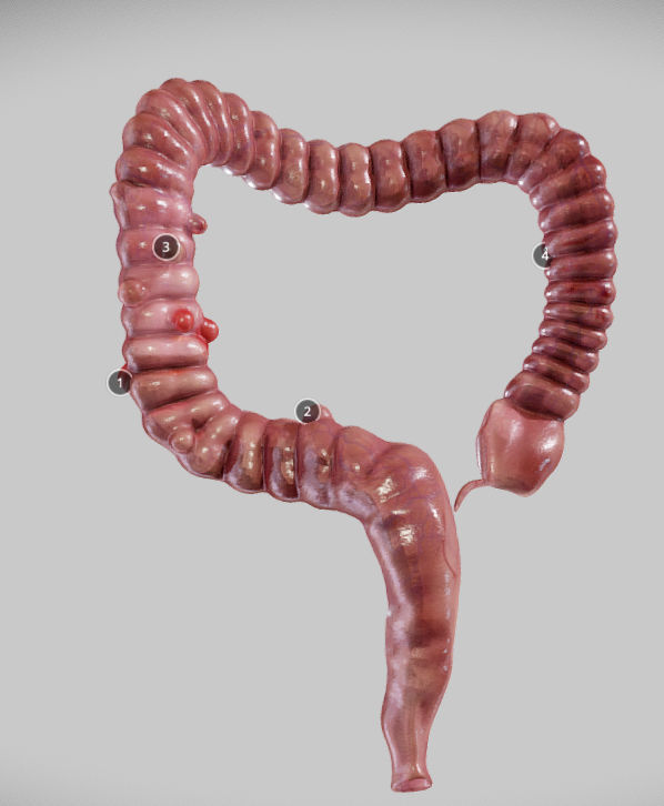 Diverticulosis and Diverticulitis Low-poly 3D model_35