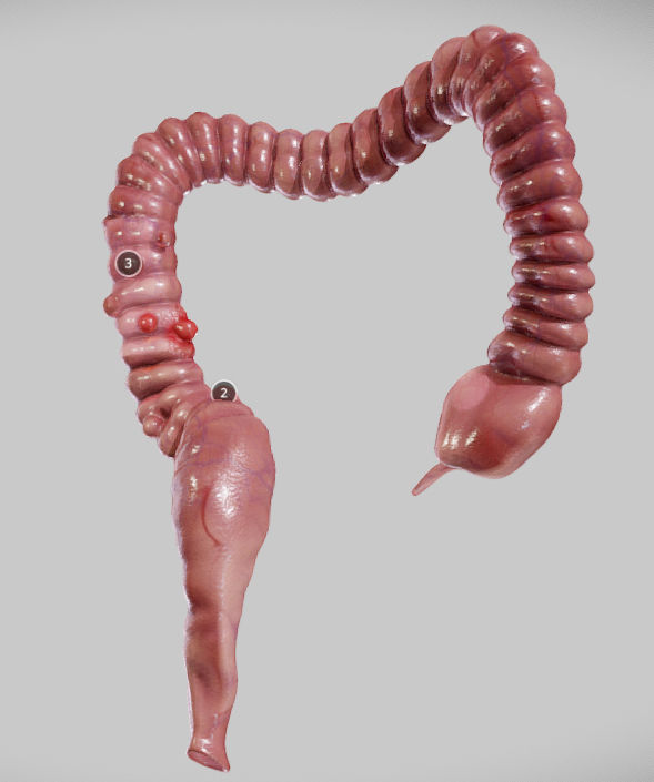 Diverticulosis and Diverticulitis Low-poly 3D model_3