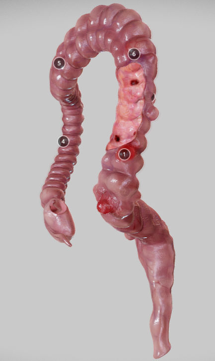 Diverticulosis and Diverticulitis Low-poly 3D model_30