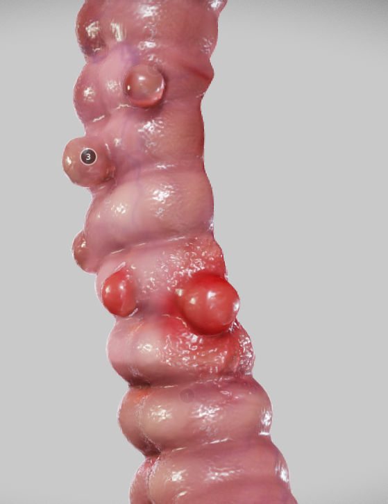 Diverticulosis and Diverticulitis Low-poly 3D model_20