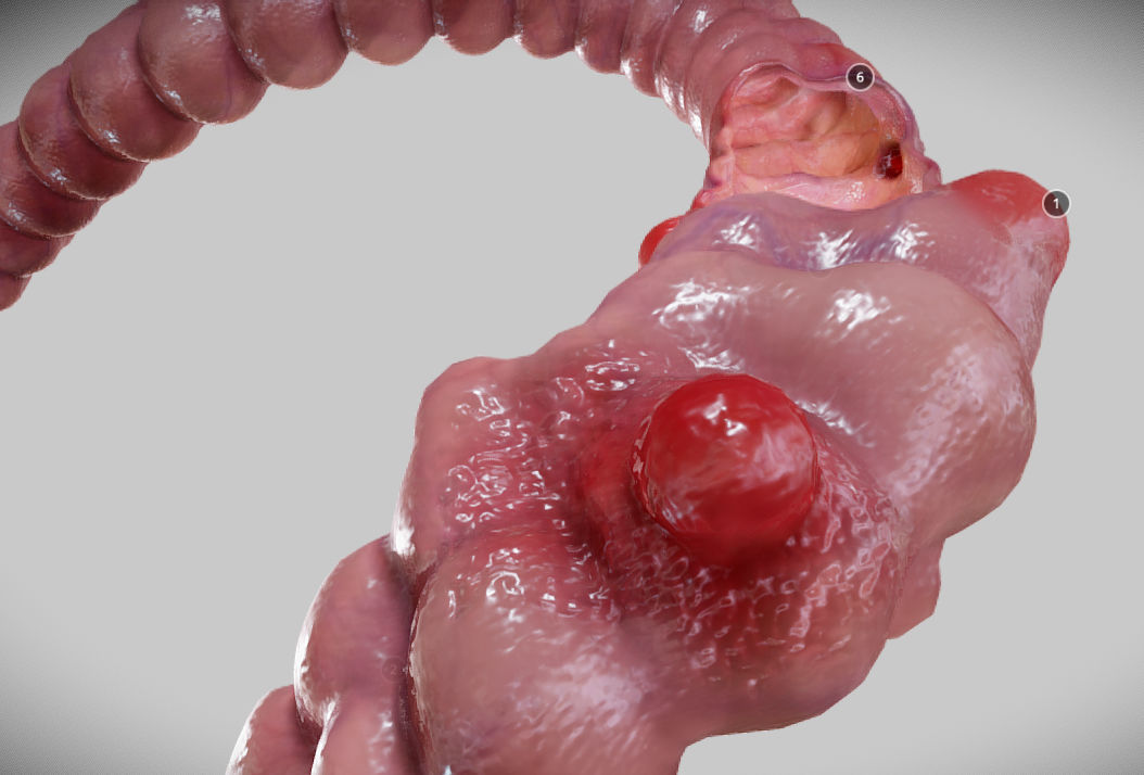 Diverticulosis and Diverticulitis Low-poly 3D model_19
