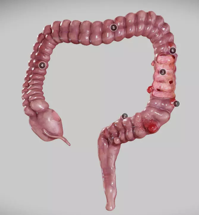 Diverticulosis and Diverticulitis Low-poly 3D model_0
