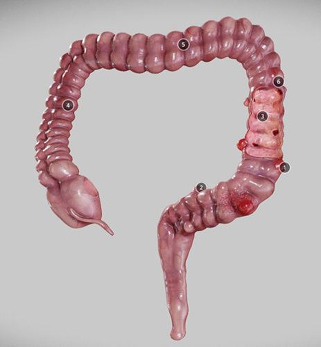 Diverticulosis and Diverticulitis Low-poly 3D model