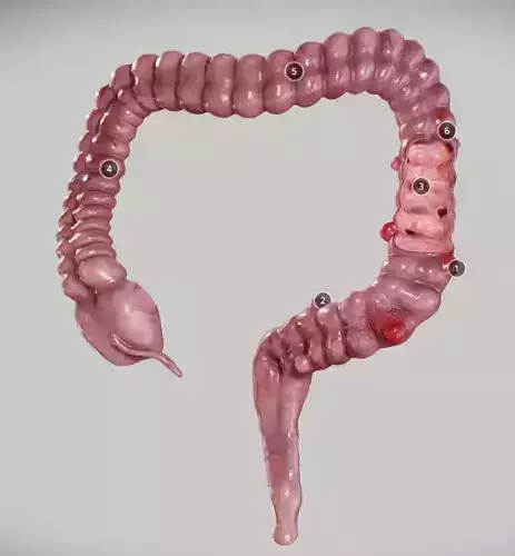 Diverticulosis and Diverticulitis Low-poly 3D model