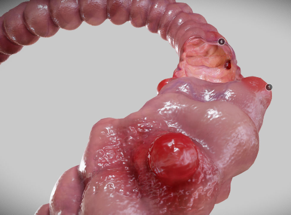Diverticulosis and Diverticulitis Low-poly 3D model_25