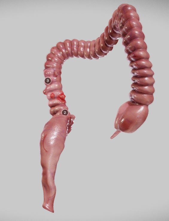 Diverticulosis and Diverticulitis Low-poly 3D model_4