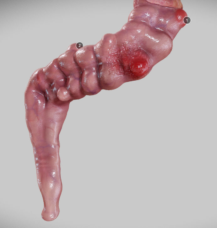 Diverticulosis and Diverticulitis Low-poly 3D model_17