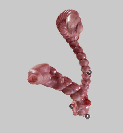 Diverticulosis and Diverticulitis Low-poly 3D model_15