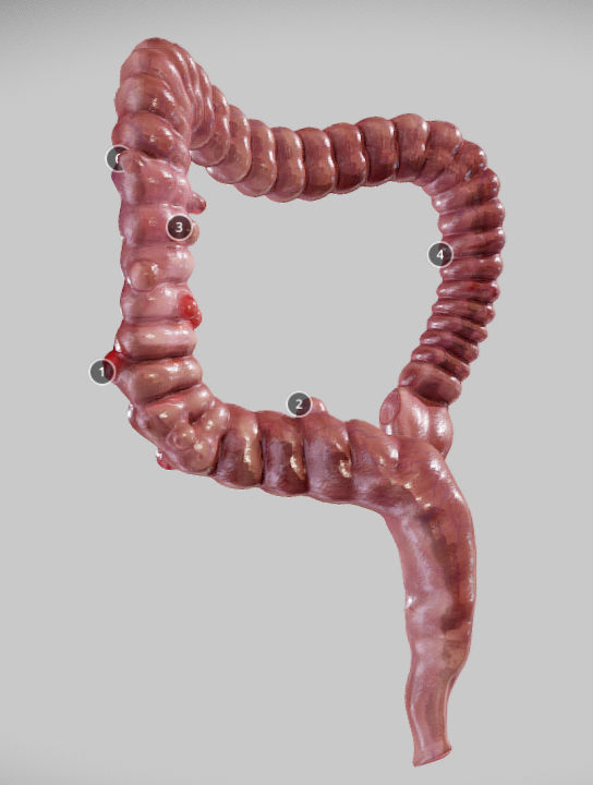 Diverticulosis and Diverticulitis Low-poly 3D model_34