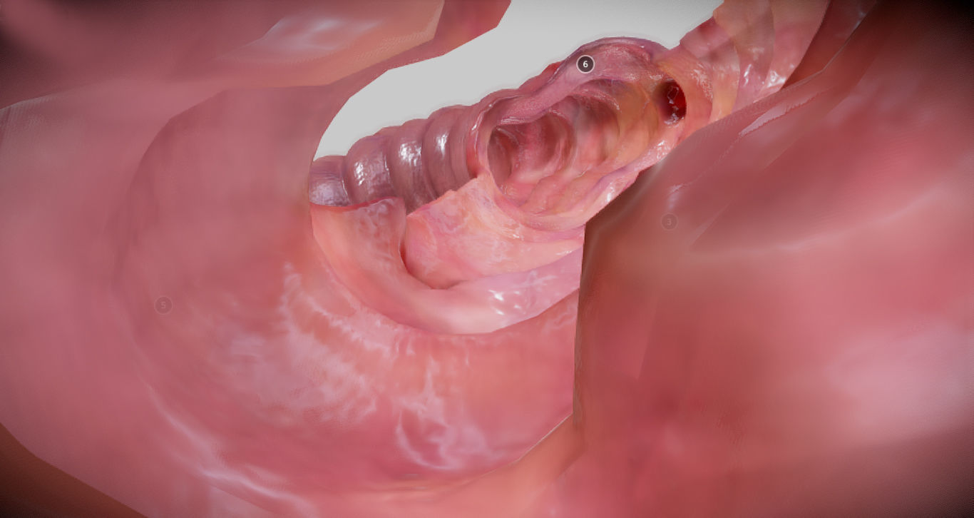 Diverticulosis and Diverticulitis Low-poly 3D model_26