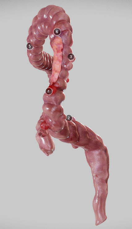 Diverticulosis and Diverticulitis Low-poly 3D model_31
