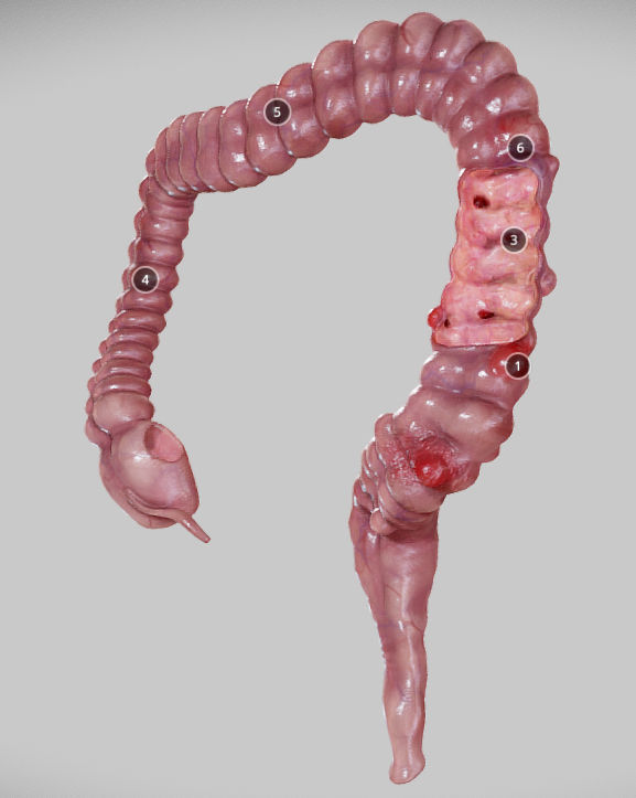 Diverticulosis and Diverticulitis Low-poly 3D model_11