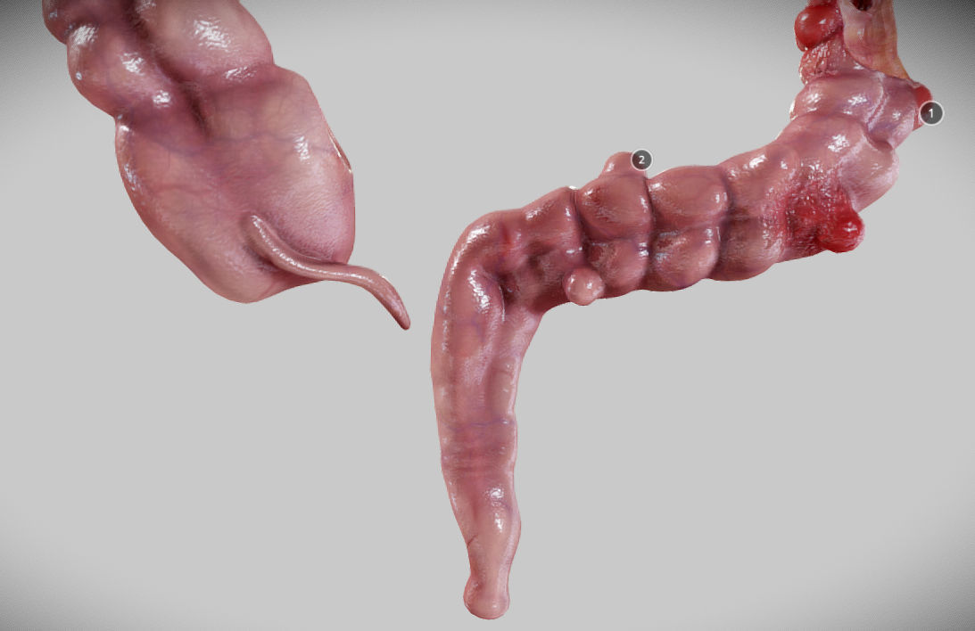Diverticulosis and Diverticulitis Low-poly 3D model_16