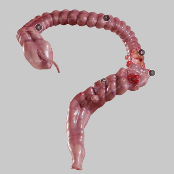 Diverticulosis and Diverticulitis Low-poly 3D model_13