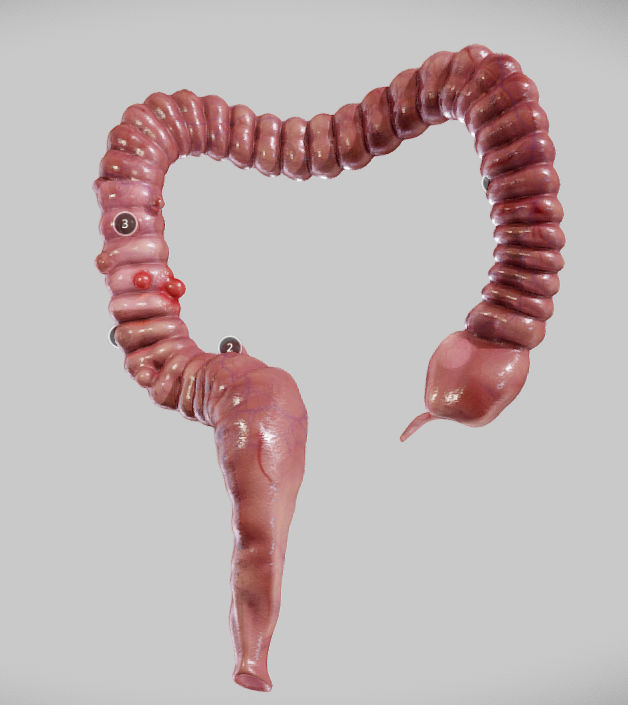 Diverticulosis and Diverticulitis Low-poly 3D model_2
