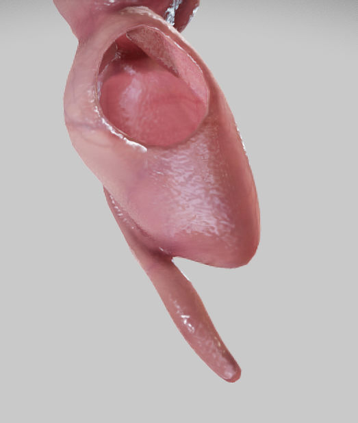 Diverticulosis and Diverticulitis Low-poly 3D model_28