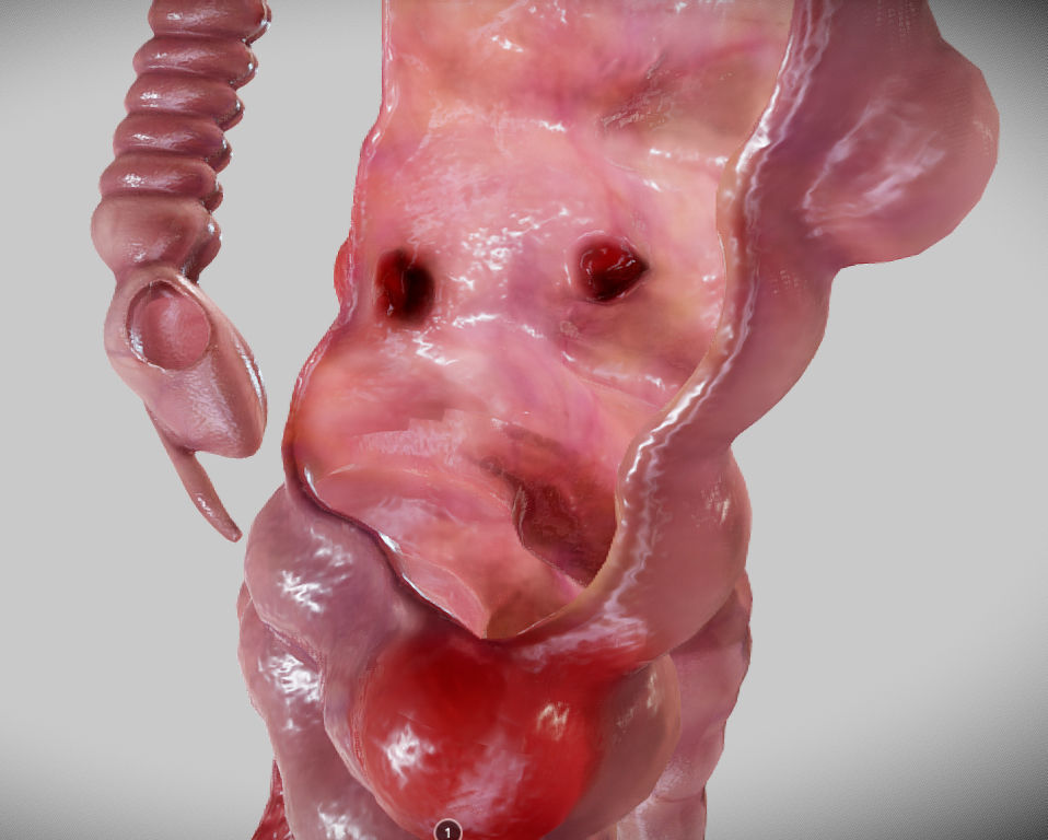 Diverticulosis and Diverticulitis Low-poly 3D model_27