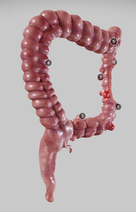 Diverticulosis and Diverticulitis Low-poly 3D model_8