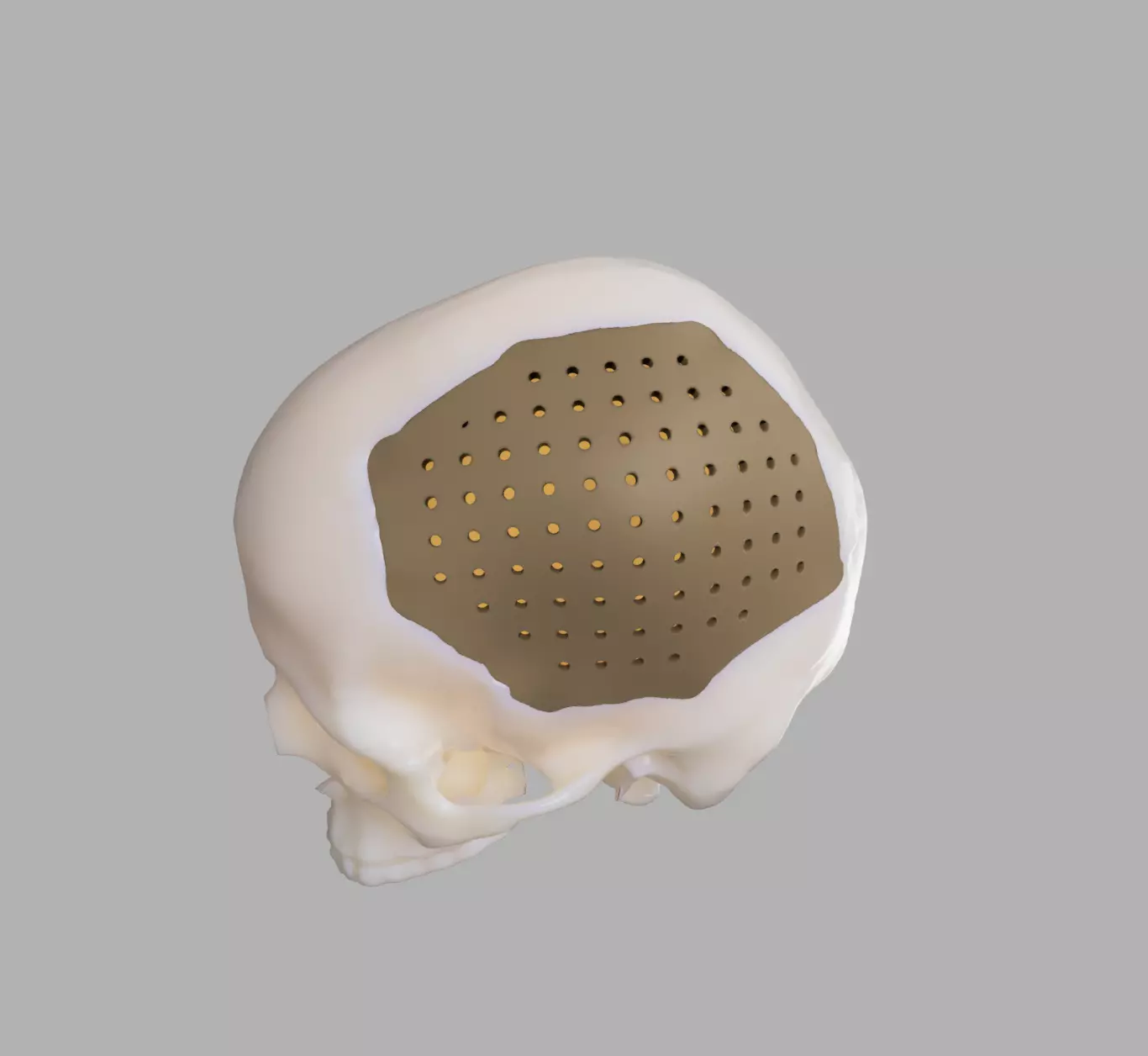 Cranium with defect and prosthesis 3D print model