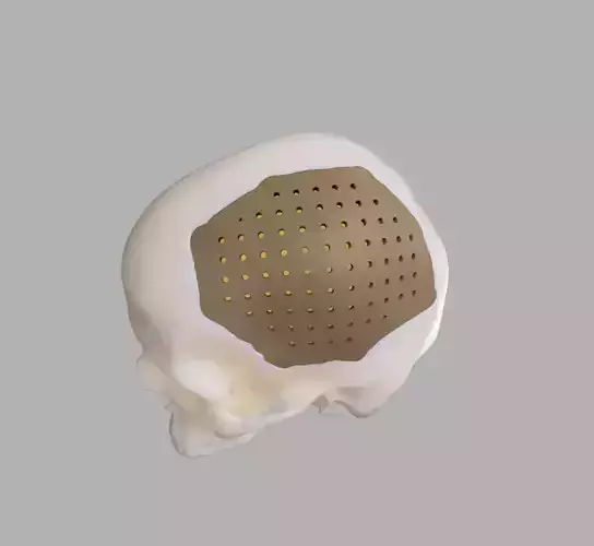 Cranium with defect and prosthesis 3D print model