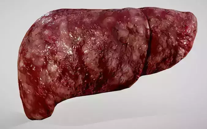 Hepatocellular Carcinoma HCC - Liver Cancer Low-poly 3D model