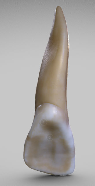 White Spot Lesions Low-poly 3D model_10