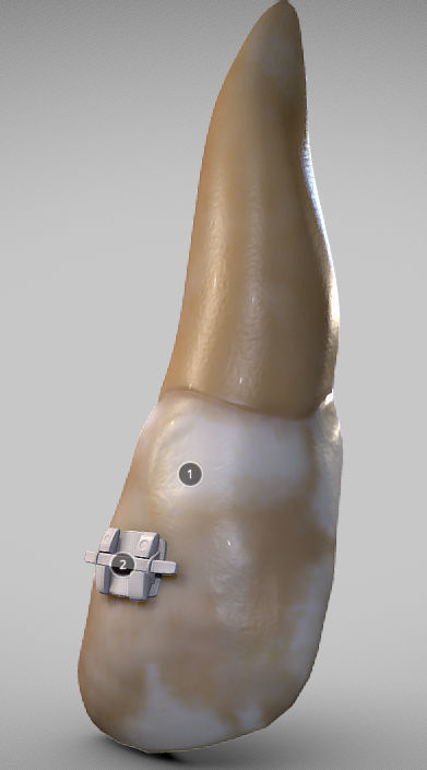 White Spot Lesions Low-poly 3D model_8