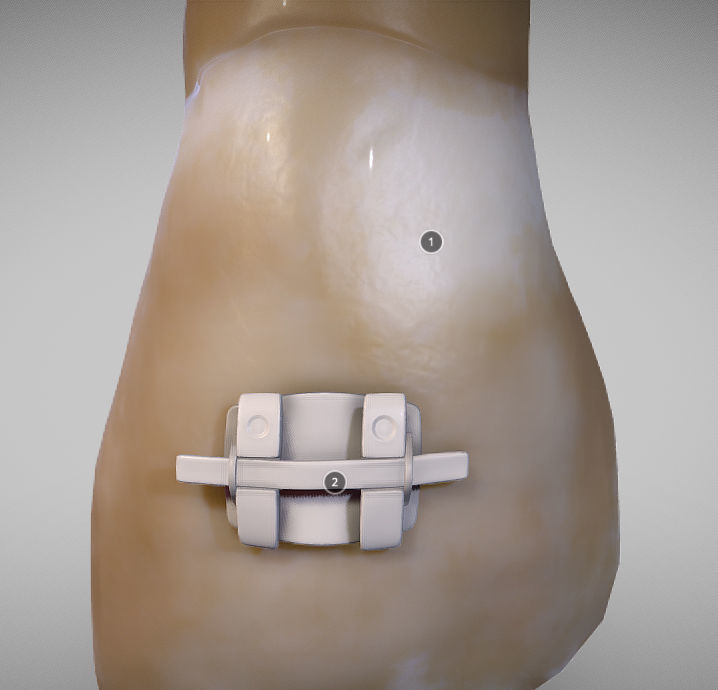White Spot Lesions Low-poly 3D model_6