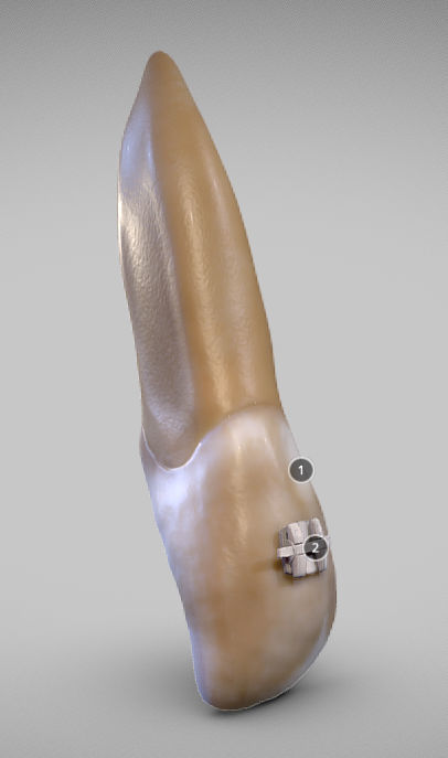 White Spot Lesions Low-poly 3D model_13