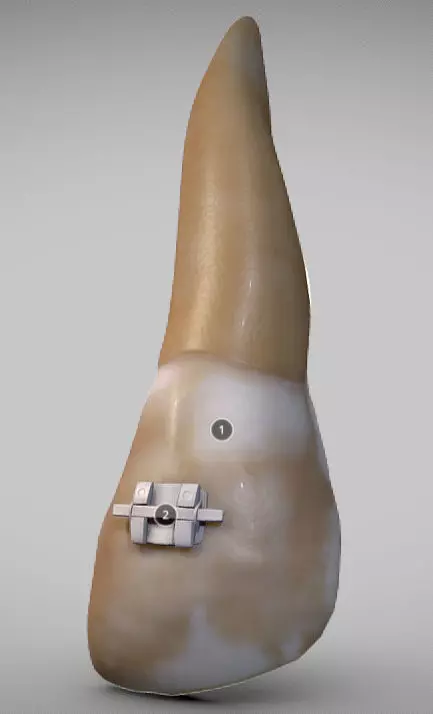 White Spot Lesions Low-poly 3D model_0