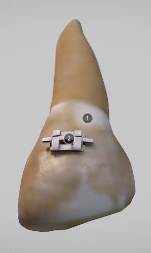 White Spot Lesions Low-poly 3D model_15