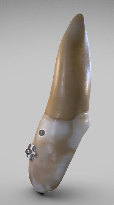 White Spot Lesions Low-poly 3D model_9