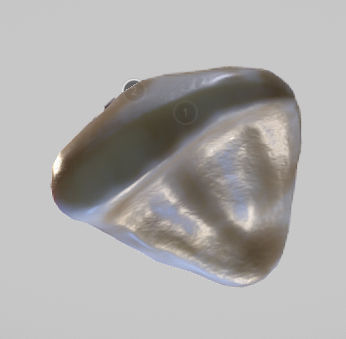 White Spot Lesions Low-poly 3D model_1