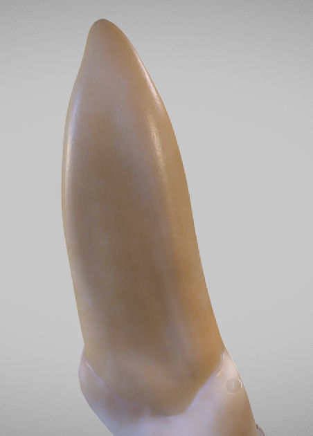 White Spot Lesions Low-poly 3D model_3