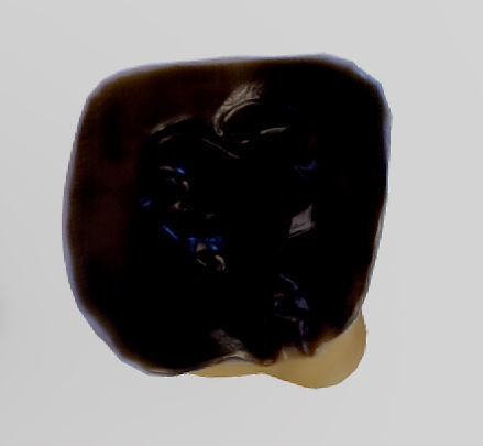 Tooth Decay Progression Dental Caries Low-poly 3D model_18