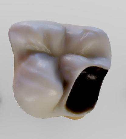 Tooth Decay Progression Dental Caries Low-poly 3D model_16